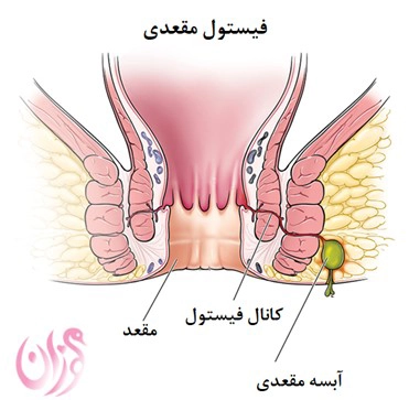 عکس فیستول
