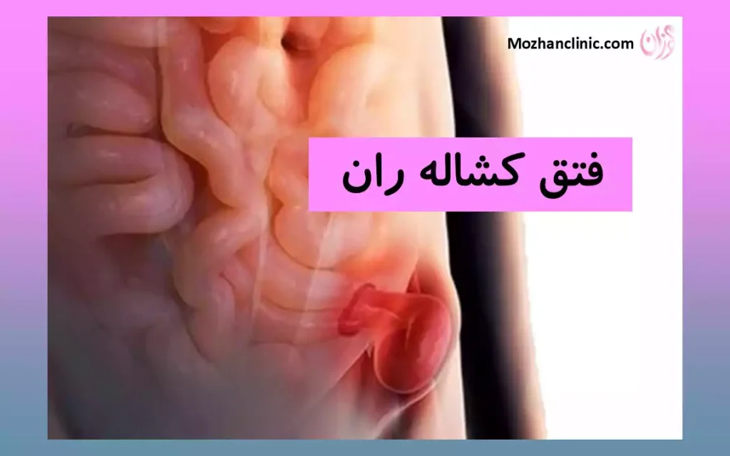 فتق کشاله ران