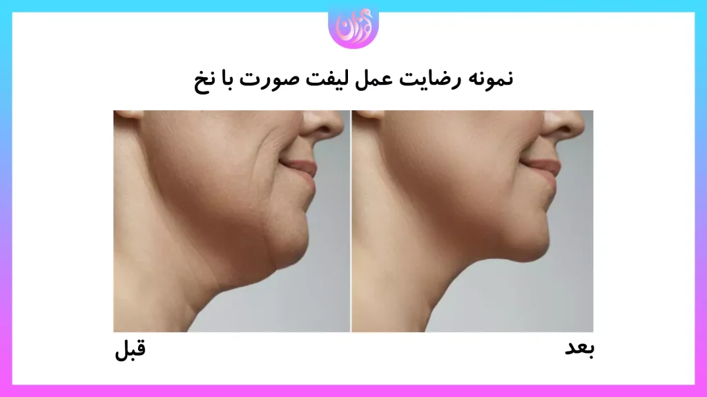 نمونه نتیجه لیفت صورت با نخ
