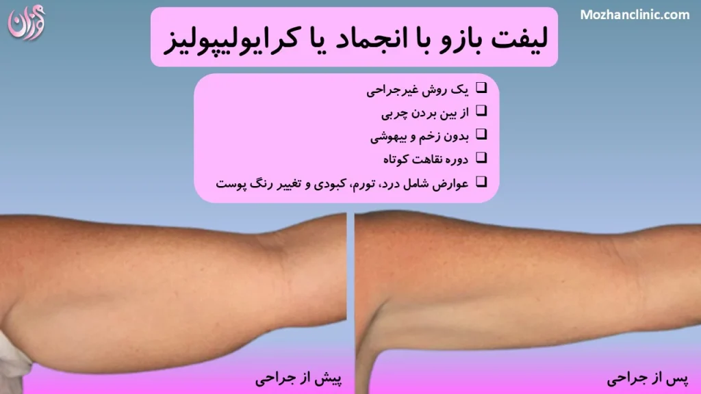 لیفت بازو با انجماد یا کرایولیپولیز: