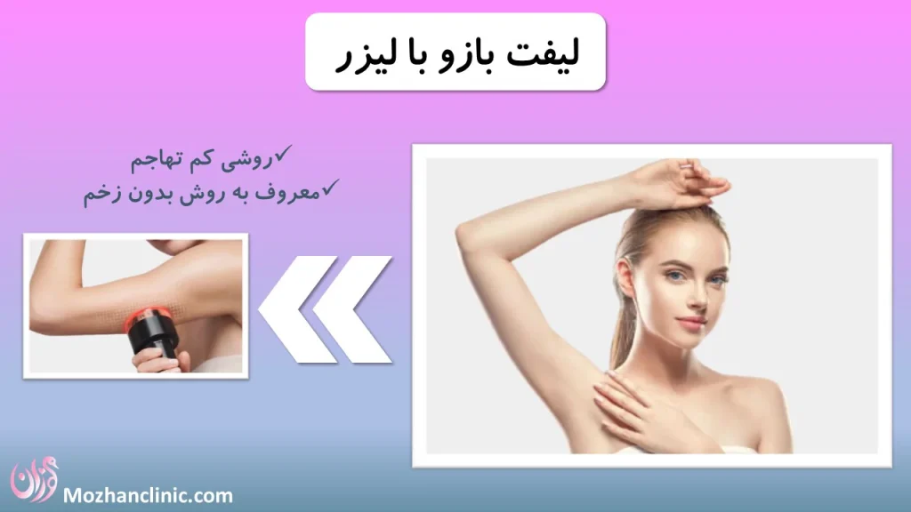 لیفت بازو با لیزر
