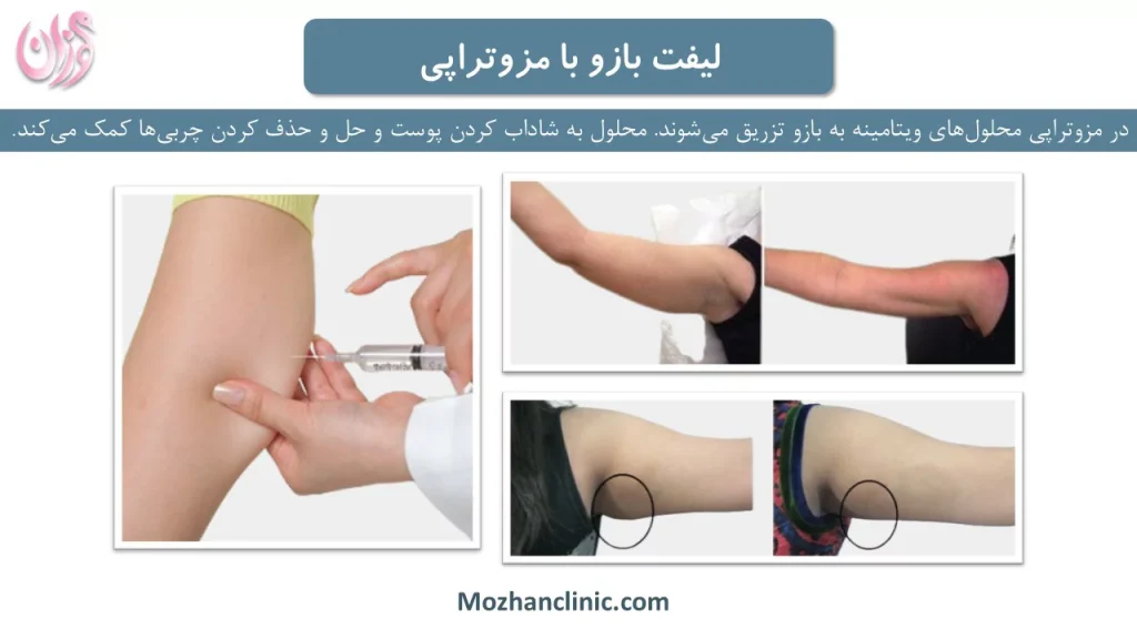 مزوتراپی