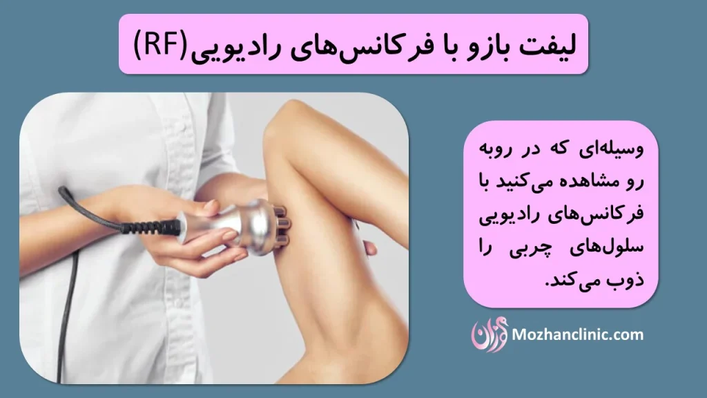 لیفت بازو با فرکانسهای رادیویی (RF):