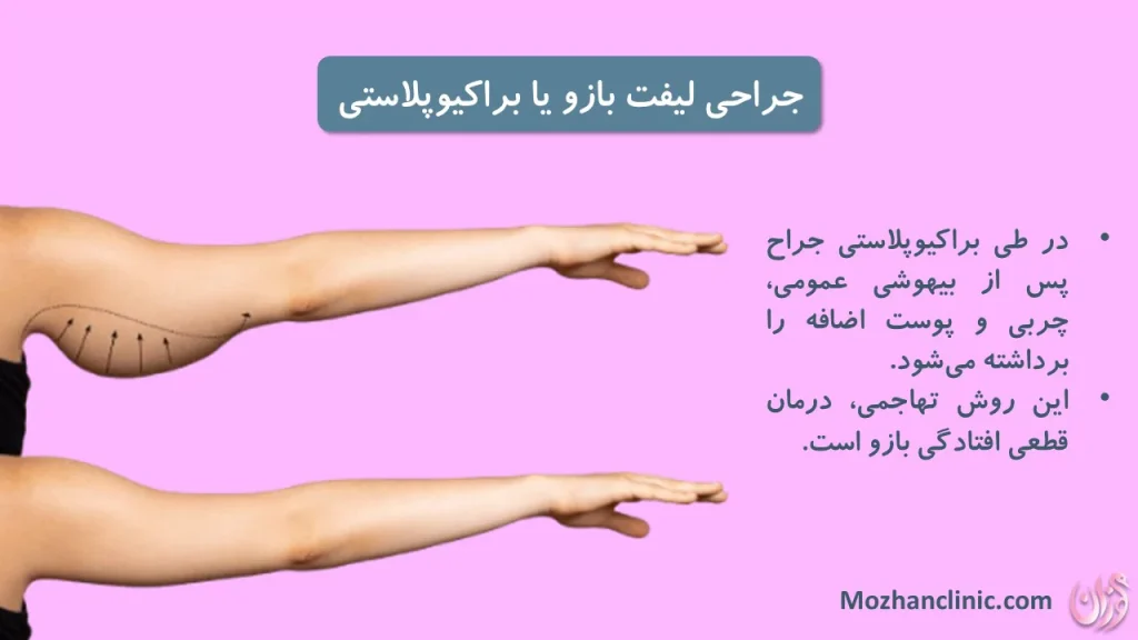 براکیوپلاستی یا جراحی لیفت بازو: