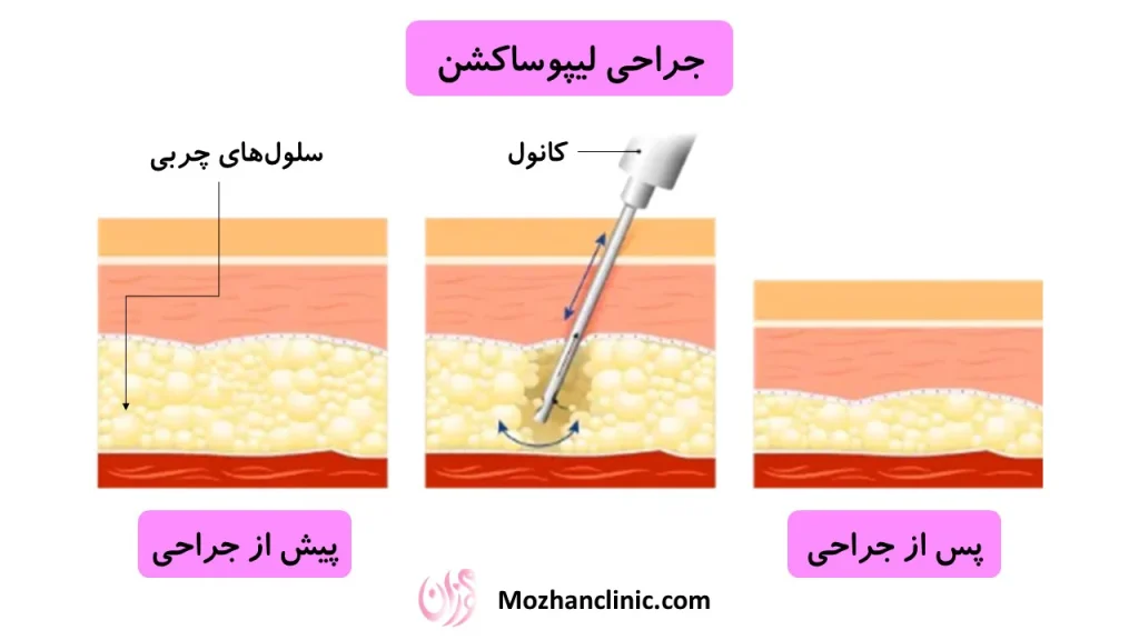 لیپوساکشن